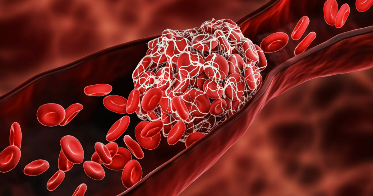 Blood clots symptoms and causes • Heart Research Institute NZ