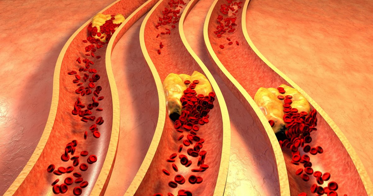 Atherosclerotic plaque in arteries overview • Heart Research Institute