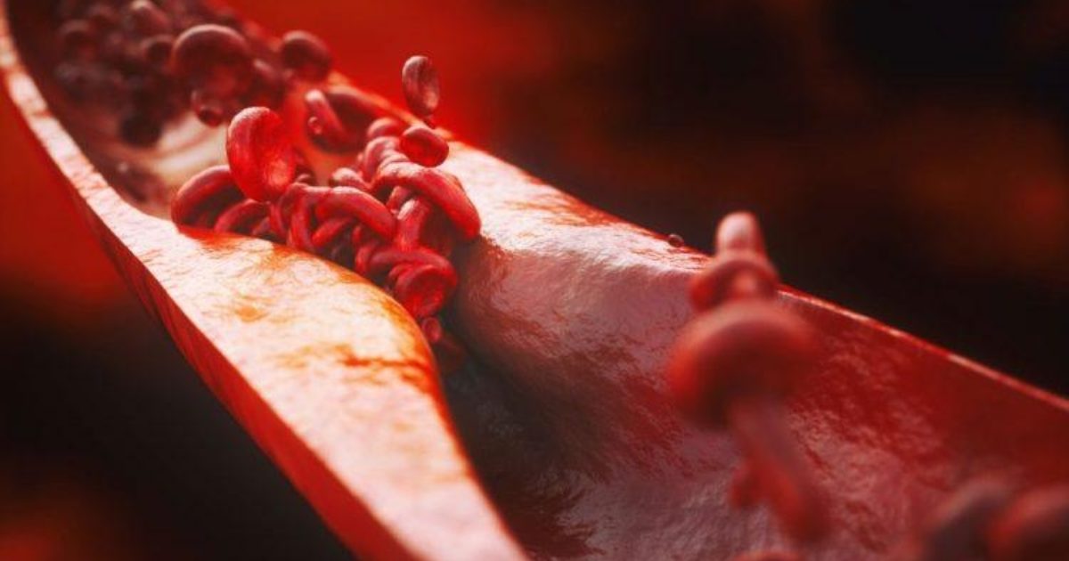 Atherosclerosis and Heart Disease • Heart Research Institute